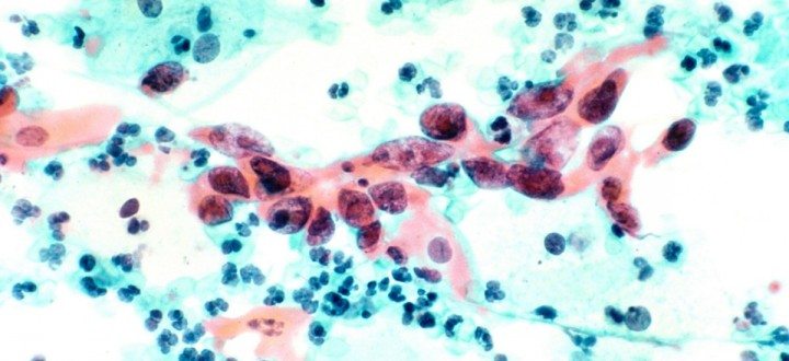Squamous_cell_carcinoma_in_the_cervix,_pap_stain